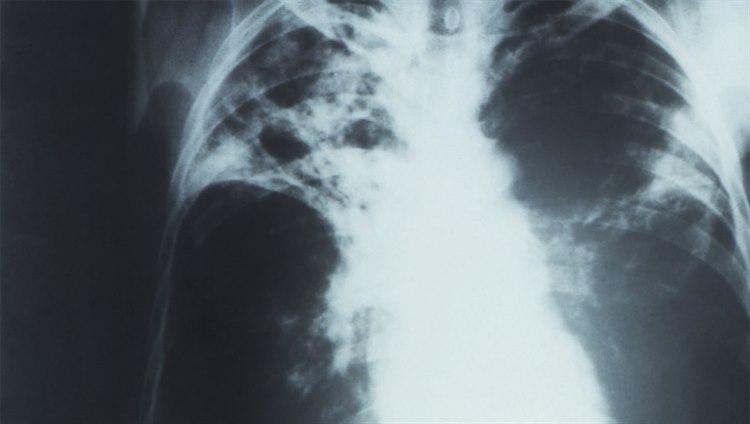Foto: PHIL - CDC: Røntgenbilde (anterioposteriort) av en pasient med diagnosen avansert, aktiv, lungetuberkulose. Bildet viser bilateralt infiltrat og typisk tuberkulose-uthuling av høyre lungetopp.