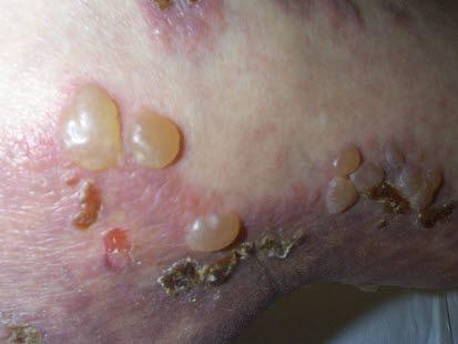 Bullous pemphigoid