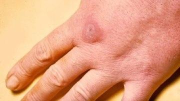 Fotoet viser erysipeloid på hånd