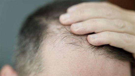 Mann tar seg til tynnhåret hode. 