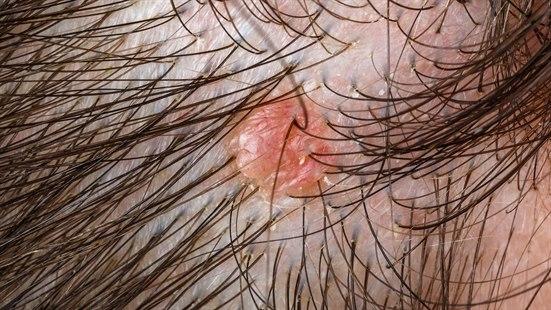 Fotoet viser nevus sebaceus i hodebunnen med vorteaktig eller knutete overflate
