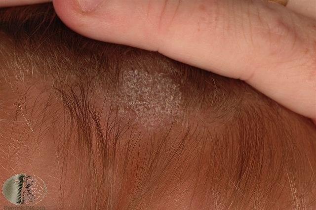 Fotoet viser tinea capitis