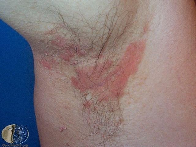 Fotoet viser seboroisk eksem, aksille