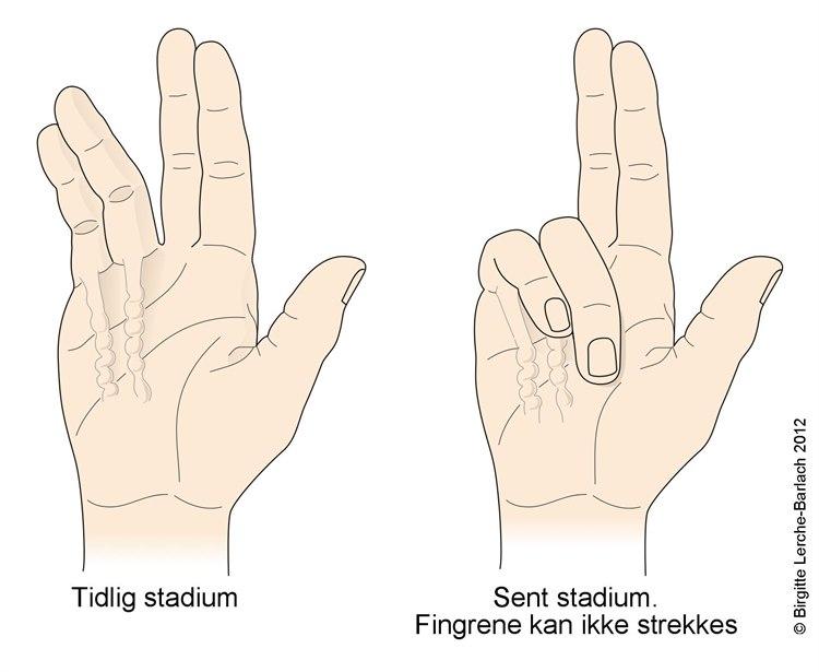 Dupuytrens kontraktur