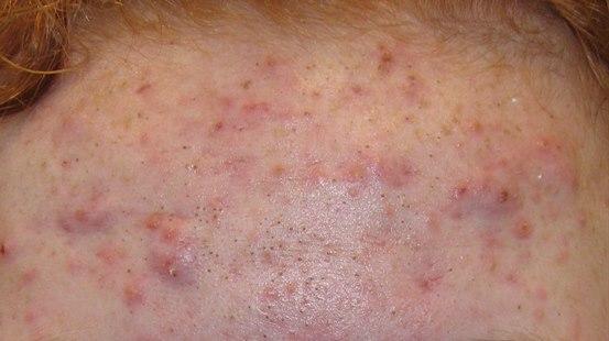 Fotoet viser akne, makrokomedoner