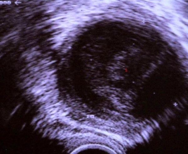 Tubo-ovariell abscess