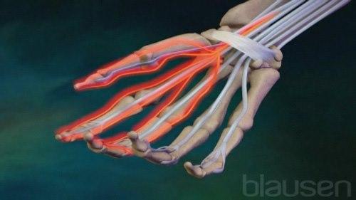 Karpal tunnel syndrom