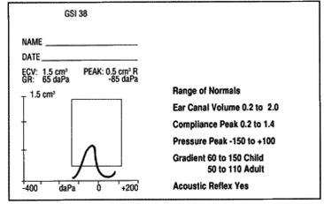 Tympanometri, normalverdier