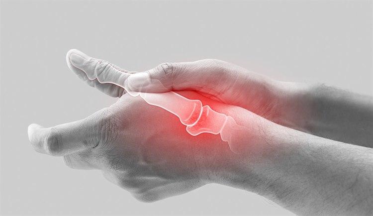 Illustrasjonsfoto av to hender med synlig smerte (rødt) fra tommelens grunnledd.
