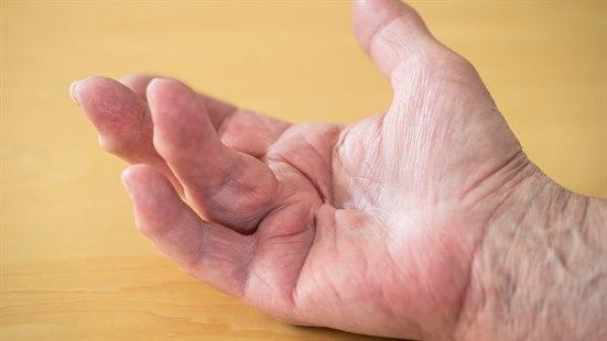 Fotoet viser Dupuytriens kontraktur