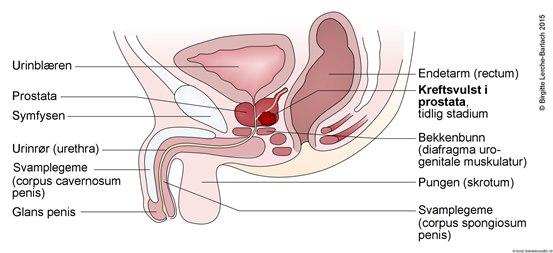 Illustrasjonen viser et lengdesnitt gjennom et mannlig underliv. Kjønnsorganene, urinblæren og endetarmen er tegnet inn. Anatomiske strukturer er fargelagt og spesifisert med piler og streker. Det er tegnet inn en kreftsvulst i prostataen. 