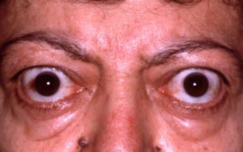 Exoftalmus, frontal