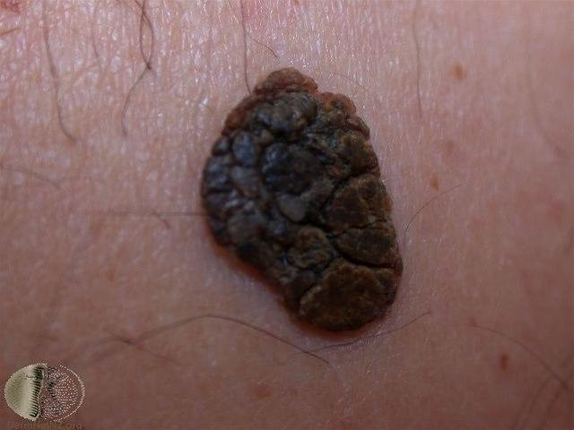 Fotoet viser seboroiske vorte