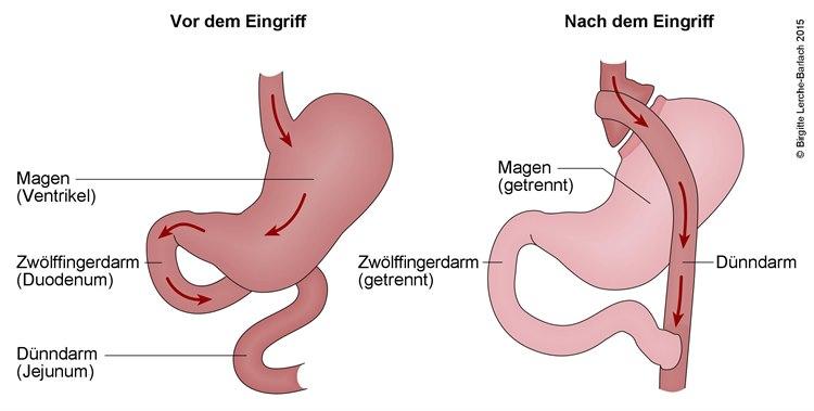 Magenbypass.jpg
