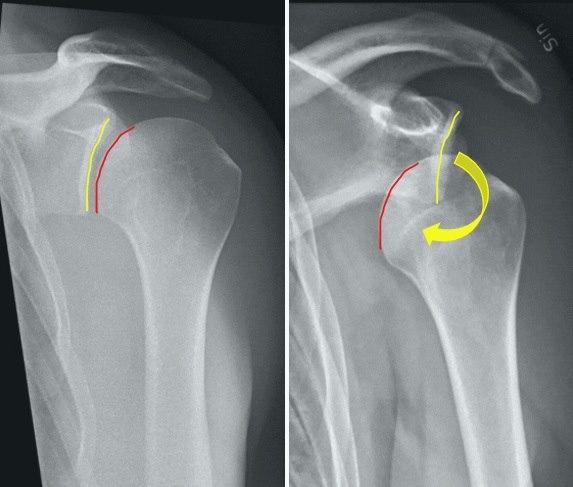 To røntgenbilder - det første viser normal skulder, det andre viser skulder ute av ledd. 