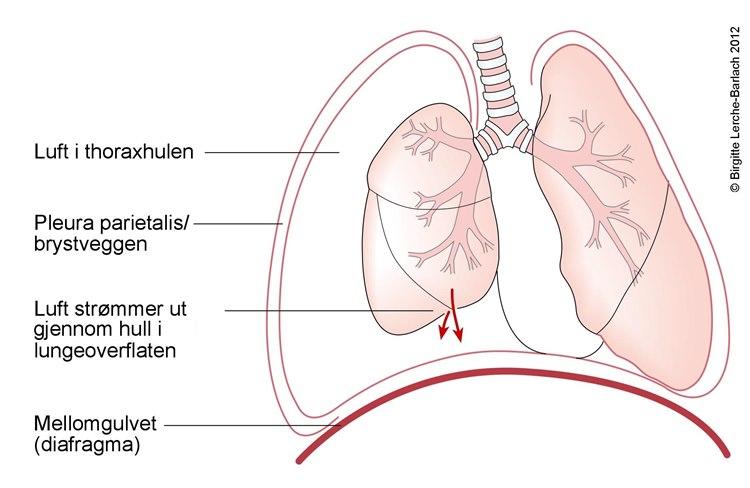 Pneumothorax - ventil