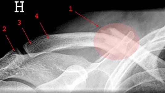 Røntgenbilde av kragebeinskade