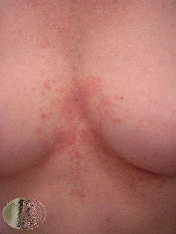Fotoet viser seboroisk dermatitt mellom brystene til en kvinne