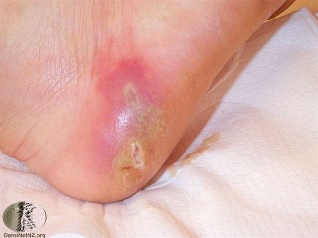 Fotoet viser abscesser i huden