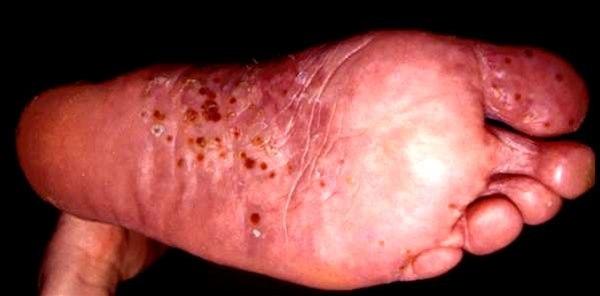 Pustulosis palmoplantaris