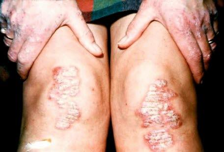 Psoriasis, knee
