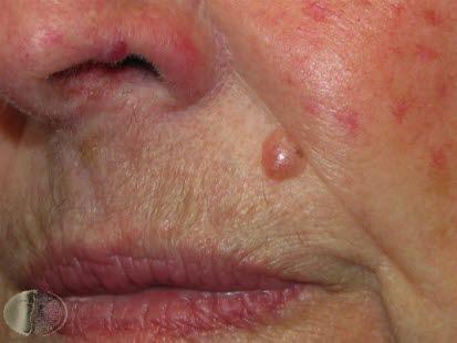 Basal cell carcinoma