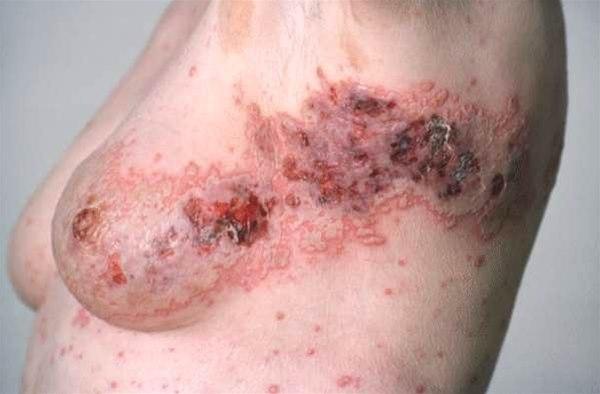 Blemmene er delvis tørket ut og erstattet av tørre skorper