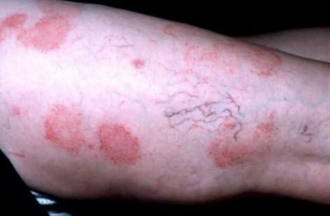 Nummulært eksem på øvre lår/hofte, ca 5. lesjoner +/- 4cm i diameter