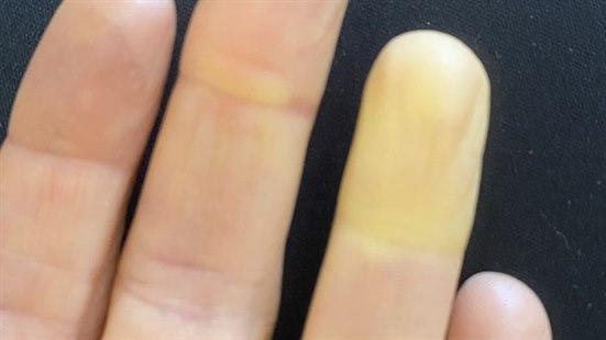 Illustrasjonsfotoet viser 4 fingre, hvor den 4 finger er avbleket