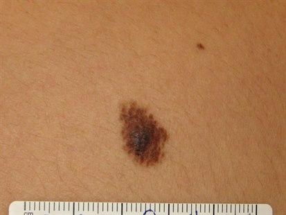 Nevus, irregulær