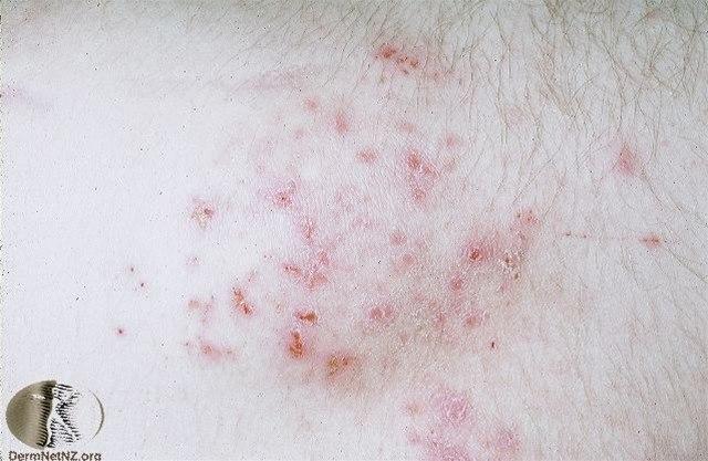 Fotoet viser dermatitis herpetiformis