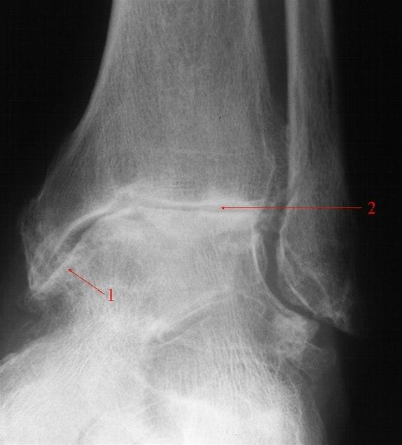 Ankelartrose, skrå front