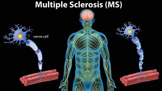 Illustrasjon av kroppens nervesystem og med tegning av normal nerve og demyelinisert nerve.