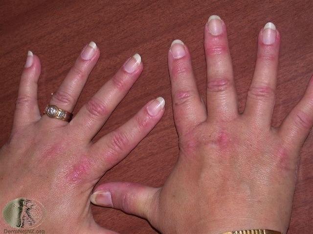 Dermatomyositt på hendene
