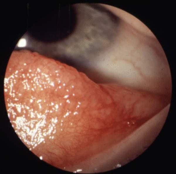 Allergisk konjunktivitt
