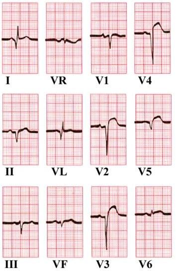 ST-heving i avledningene V2-V5.