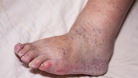 Edema ankle