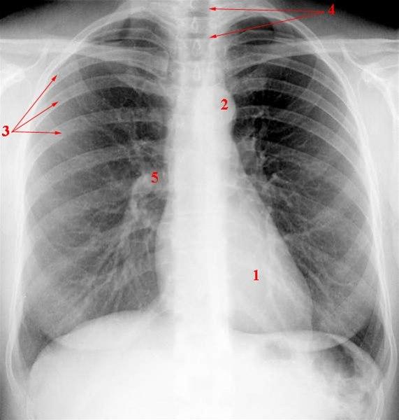 Røntgenbilde av normal brysthule