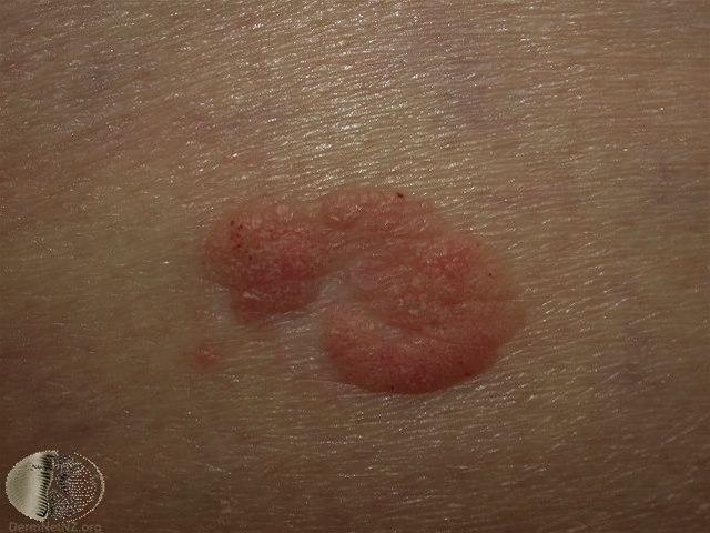 Fotoet viser seboroiske vorter