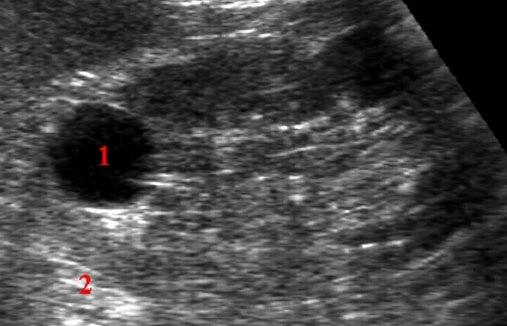 Nyrecyste - ultralydbilde