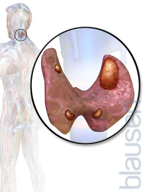 Hyperparathyroidisme