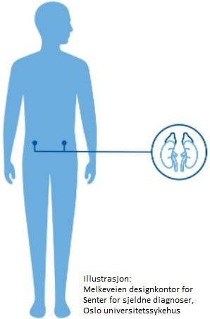 Medfødt binyrebarksvikt (CAH)