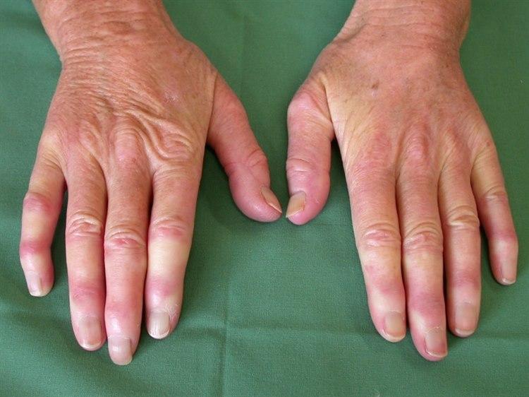 Fotoet viser nærbilde av to hender som viser tegn til Raynauds fenomen