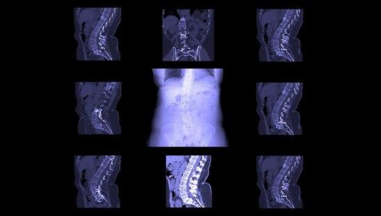 Computed tomography of the spine