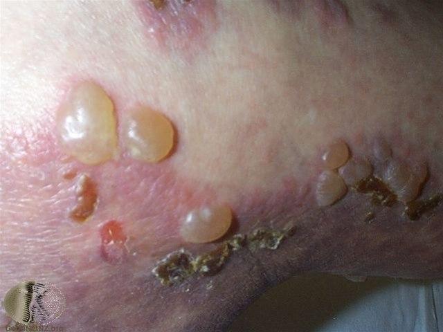 Fotoet viser pemfigoid