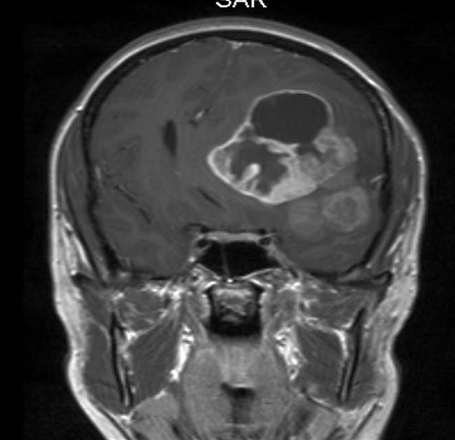 anaplastisk ependymom 2