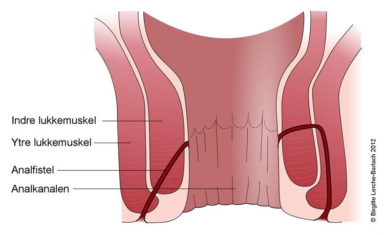 Analkanal med fistel