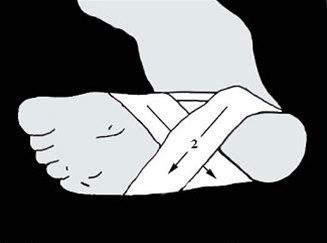 Fotsåleteiping bilde#3