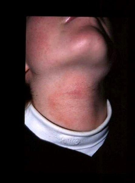 Umiddelbart etter kryobehandling av epidermal nevus.