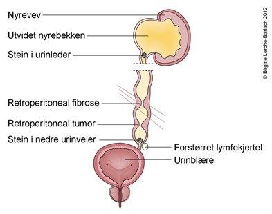 Hydronefrose, årsaker